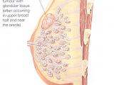 Fibroadenom (Knoten)